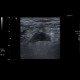 Acute appendicitis: US - Ultrasound